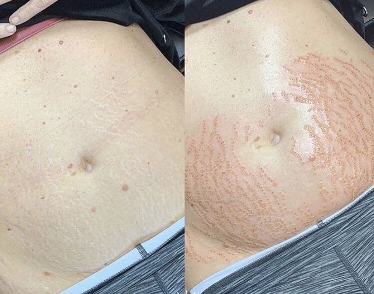 تحسين مرونة جلد الفخذين